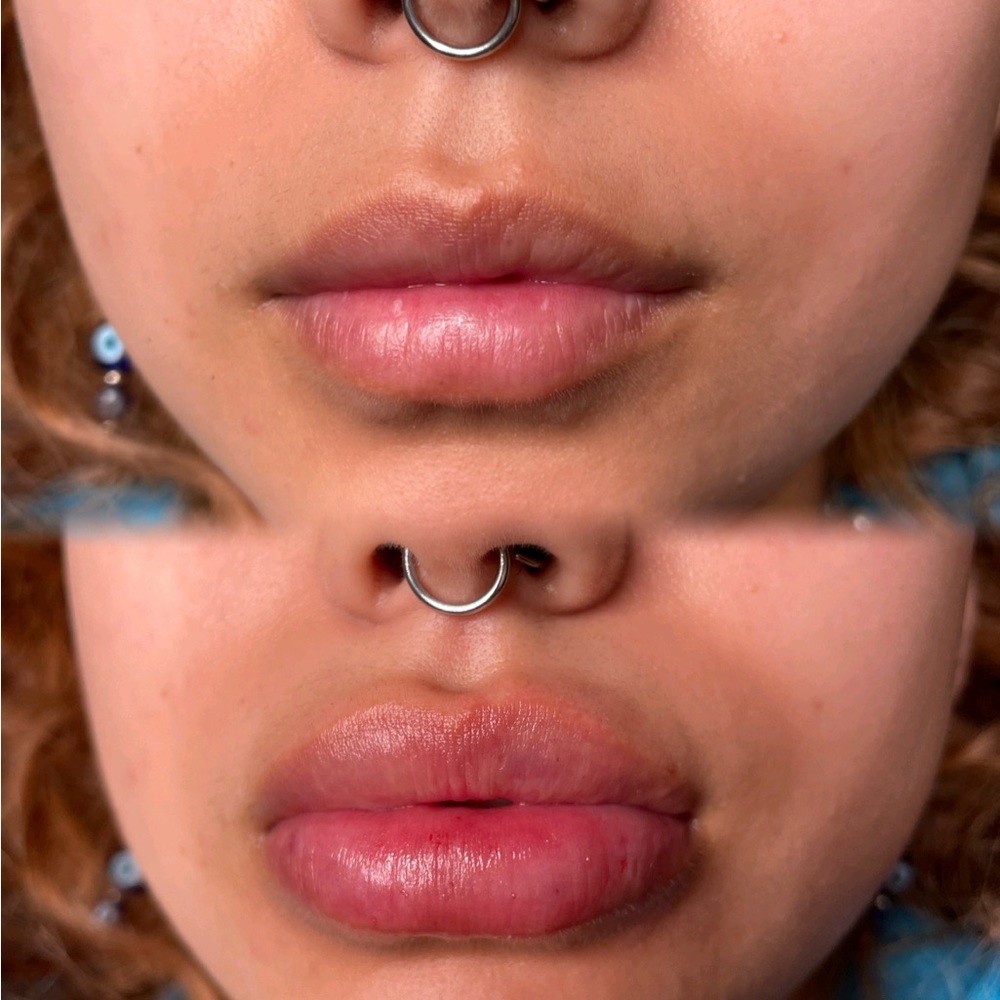 No needle-Lip filler